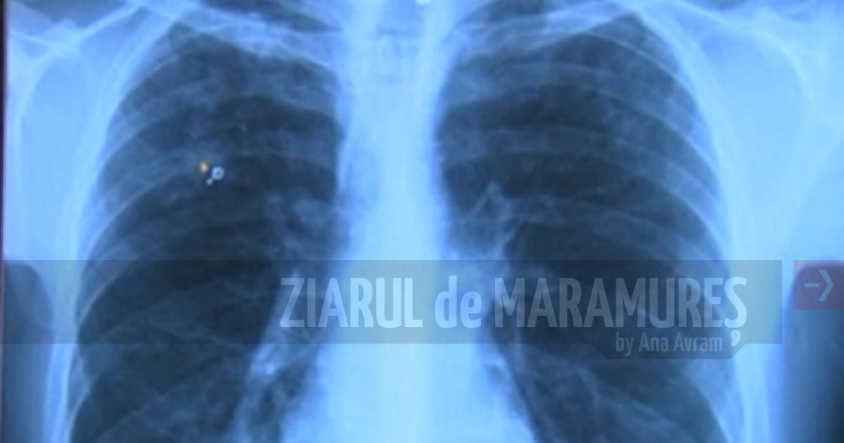 MS demarează acțiunea de depistare activă a tuberculozei în Maramureș