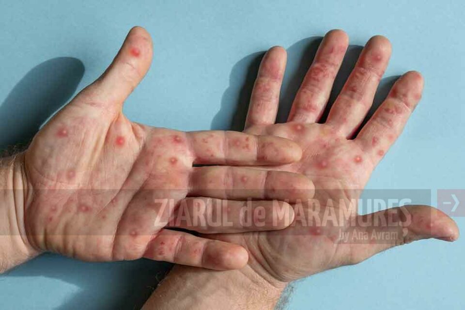 Un nou caz de variola maimuței a fost confirmat în România